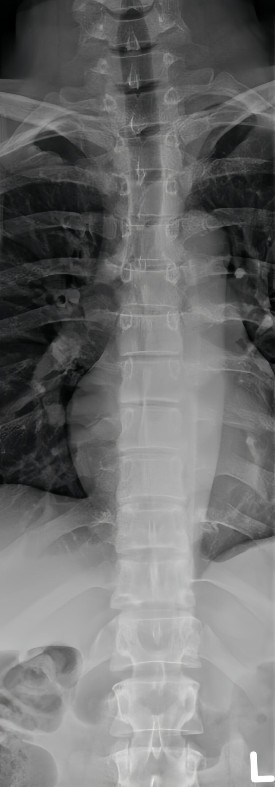 Thoracic spine X-ray showing upper and mid back imaging at Kamego Chiropractic in Almont MI serving Lapeer County