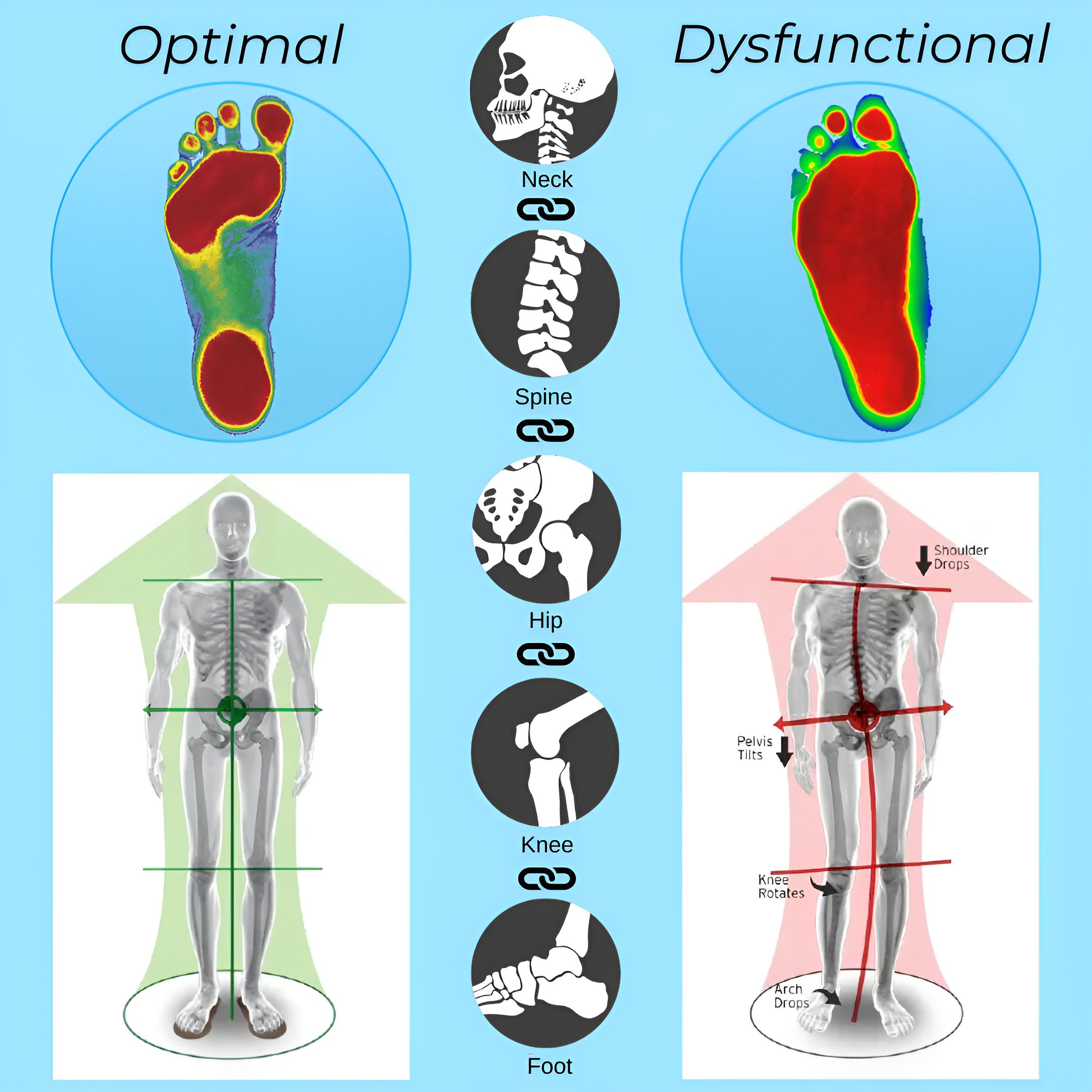Comparison of optimal vs dysfunctional foot alignment showing full body effects from feet to spine at Kamego Chiropractic Almont MI Lapeer County